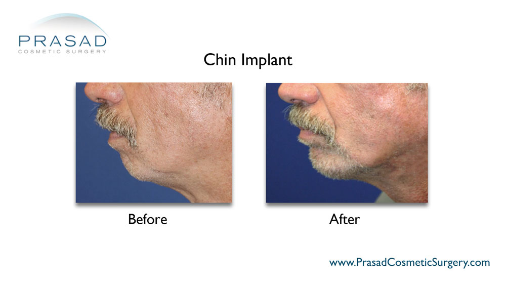 Chin implant before and after results male patient in left side view