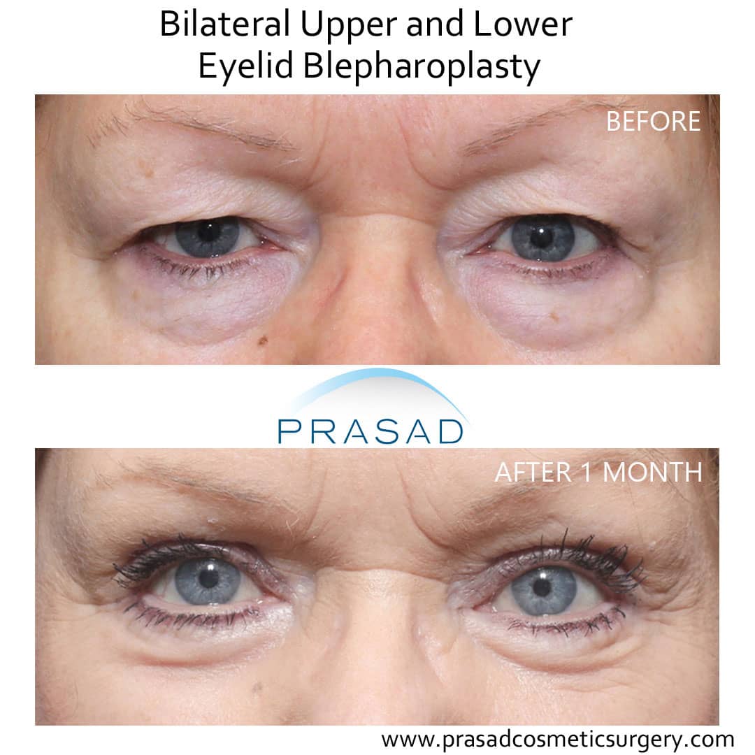 upper and lower blepharoplasty before and after 1 month recovery