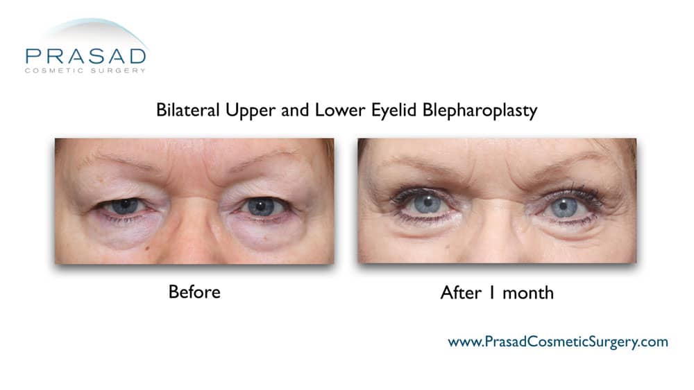 Cosmetic upper and lower eyelid blepharoplasty before and after 1 month recovery