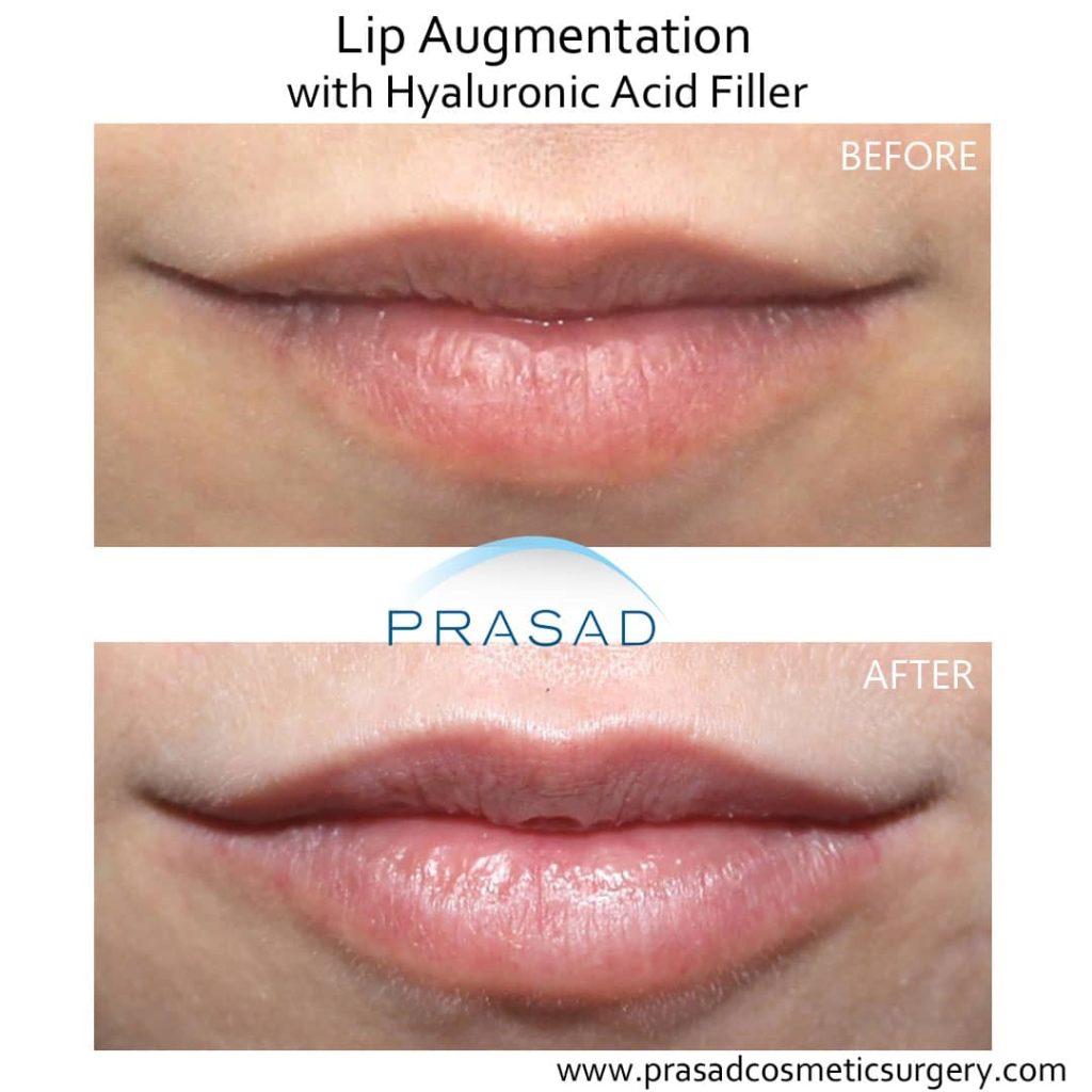 natural looking lip fillers before and after