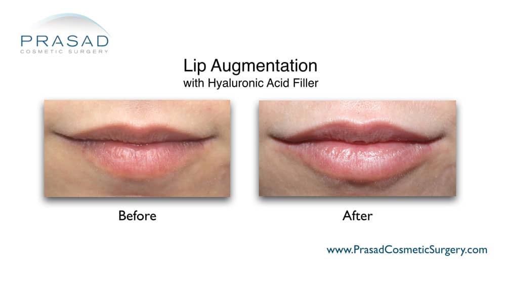 how to get natural looking lip fillers before and after