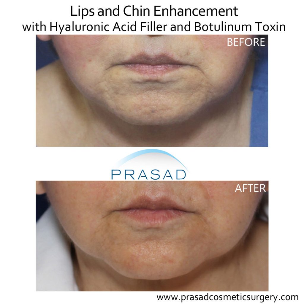 lips and chin enhancement with filler and Botox before and after