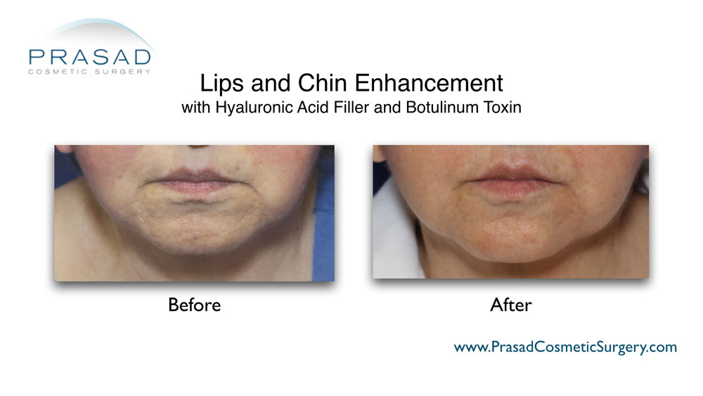 lips and chin enhancement with filler and Botox before and after female