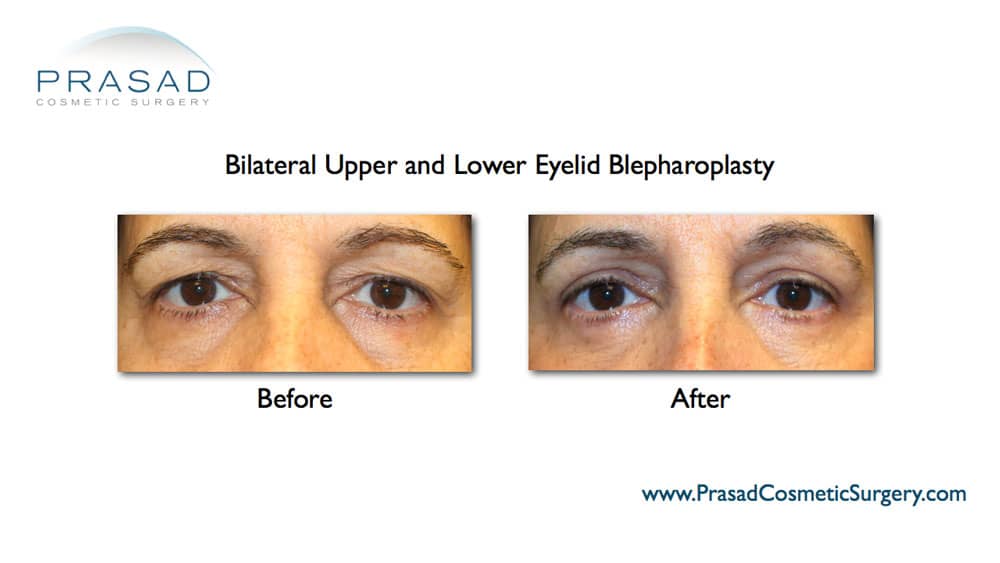 Upper and lower eyelid surgery before and after