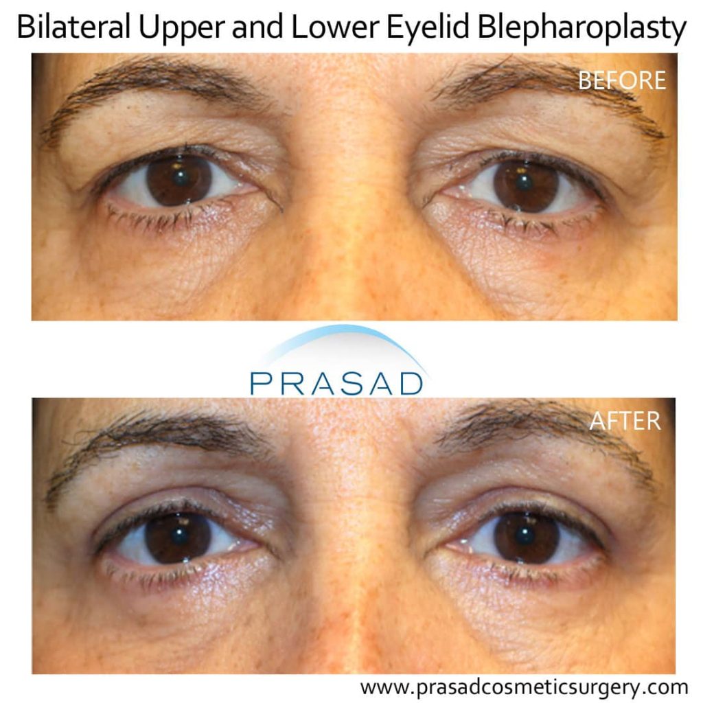 upper and lower blepharoplasty before and after complete recovery