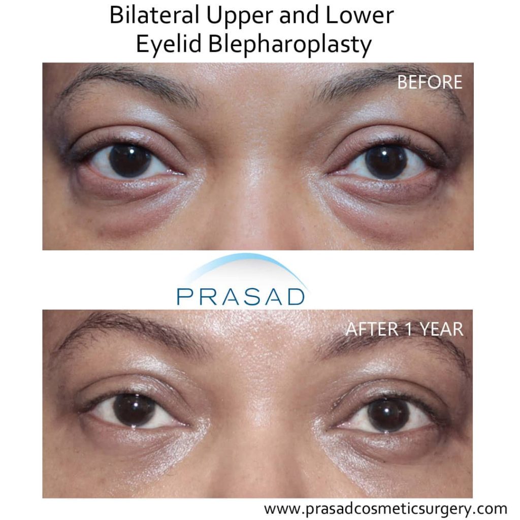 African-american female upper and lower blepharoplasty before and after 1 year recovery