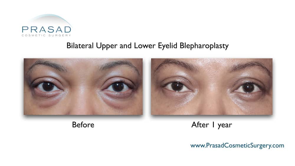 African-american female bilateral upper and lower eyelid blepharoplasty before and after 1 year recovery