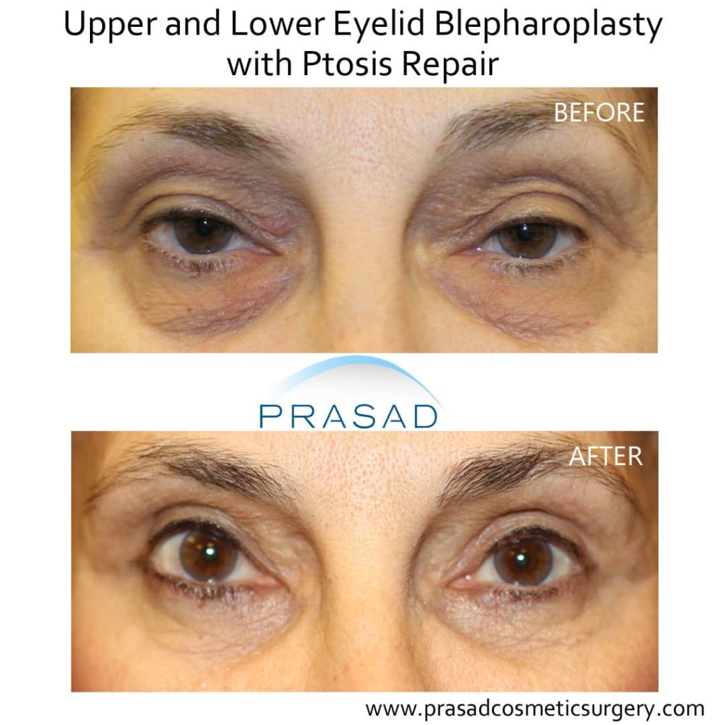 upper and lower blepharoplasty before and after with ptosis repair