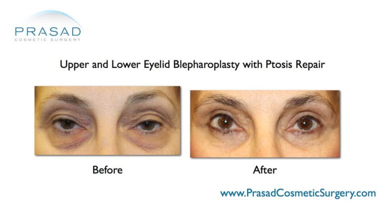 Can Upper and Lower Blepharoplasty Be Done at the Same Time?