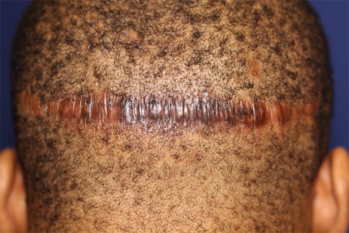 hair transplant scar