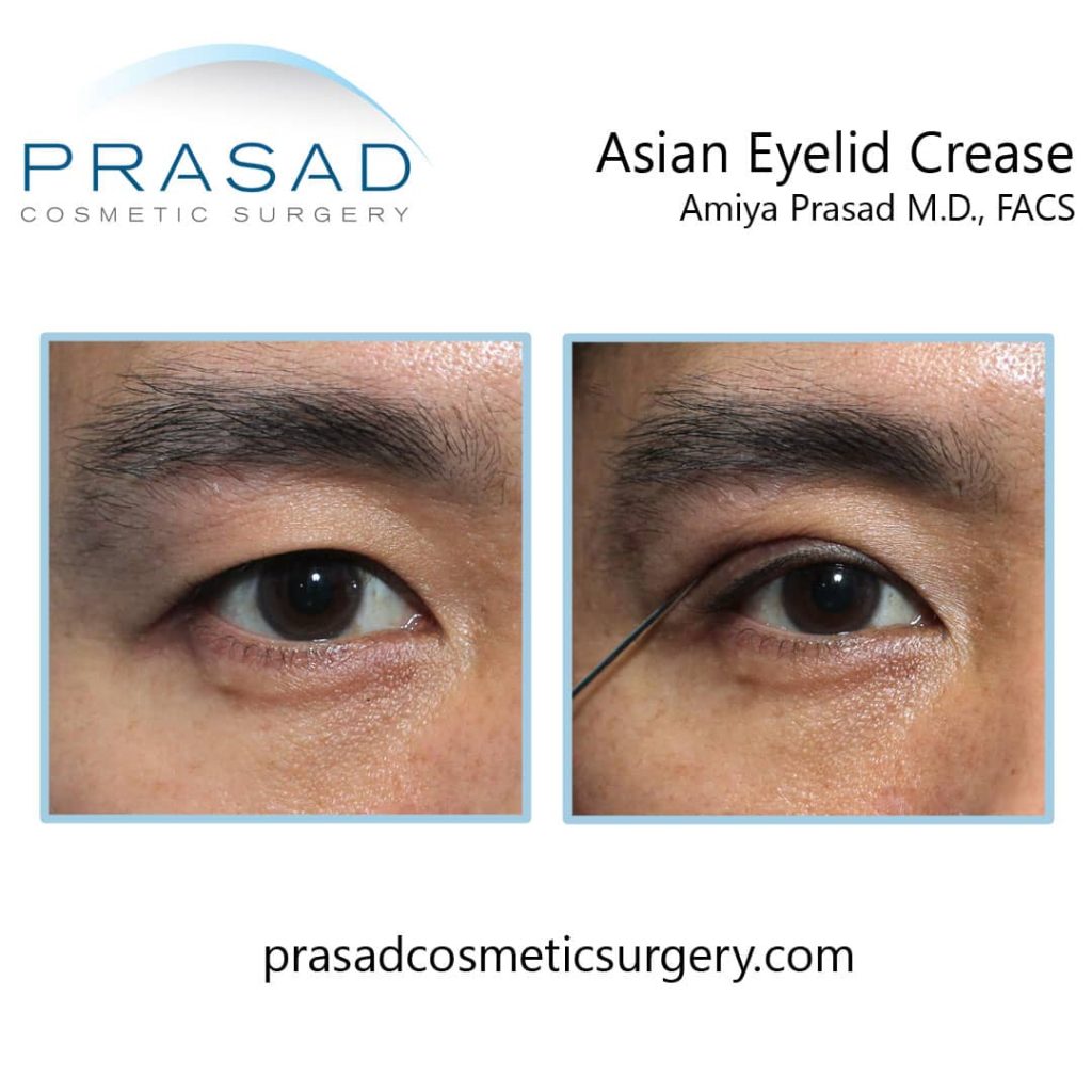 Asian eyelid crease demonstration at Prasad Cosmetic Surgery Long Island