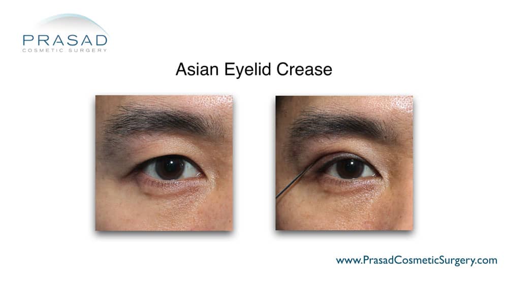 Asian eyelid crease demonstration at Prasad Cosmetic Surgery New York
