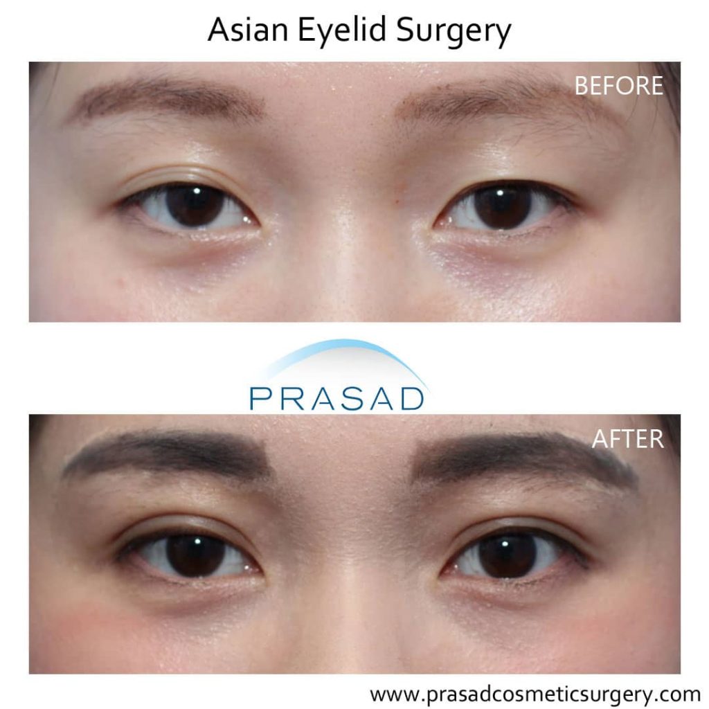 asian eyelid surgery before and after recovery female patient