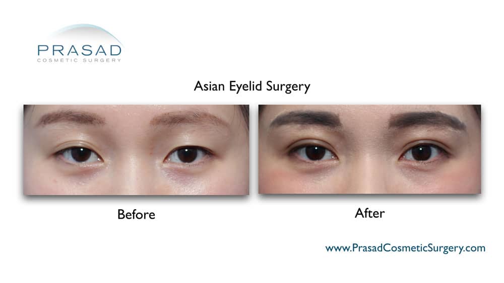 asian eyelid surgery before and after female