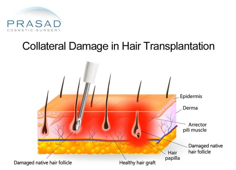 Collateral damage in hair transplantation illustration
