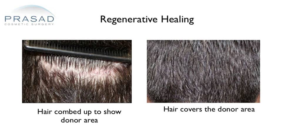 hair transplant donor area minimize hair transplant scarring