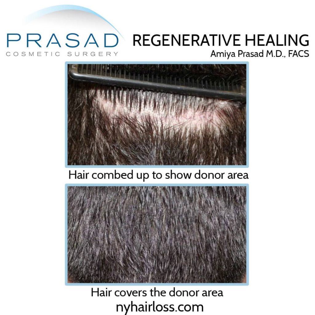hair transplant donor area healing