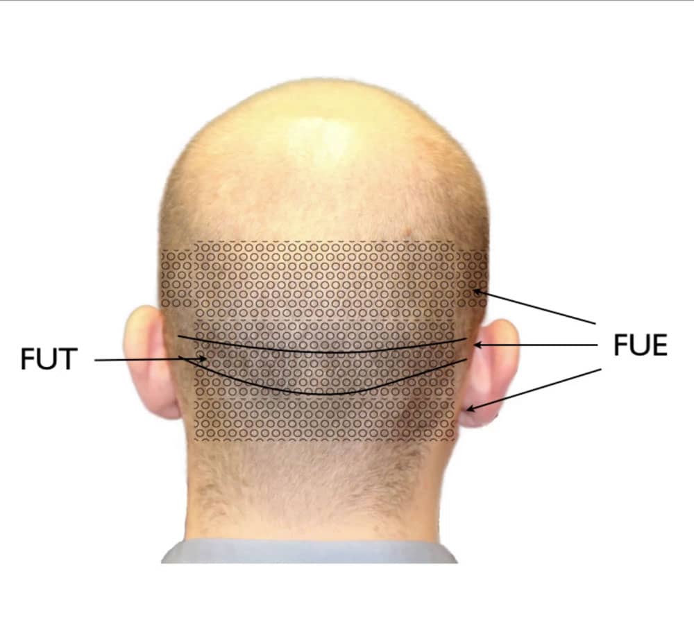 Fut vs fue hair transplant surgery donor area illustration