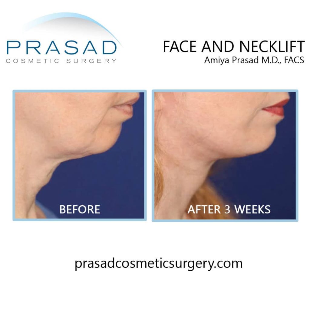 Facelift and neck lift before and after 3 weeks recovery