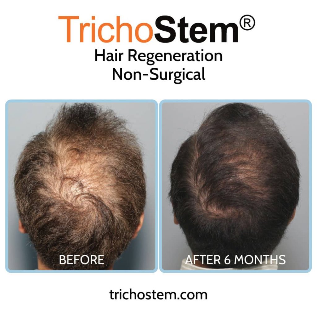 Trichostem Hair Regeneration treatment before and after 6 months