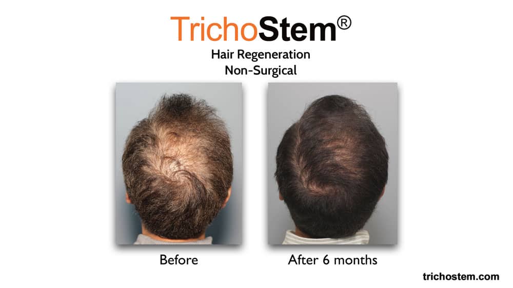 Non-surgical hair loss solution Trichostem Hair Regeneration treatment before and after 6 months