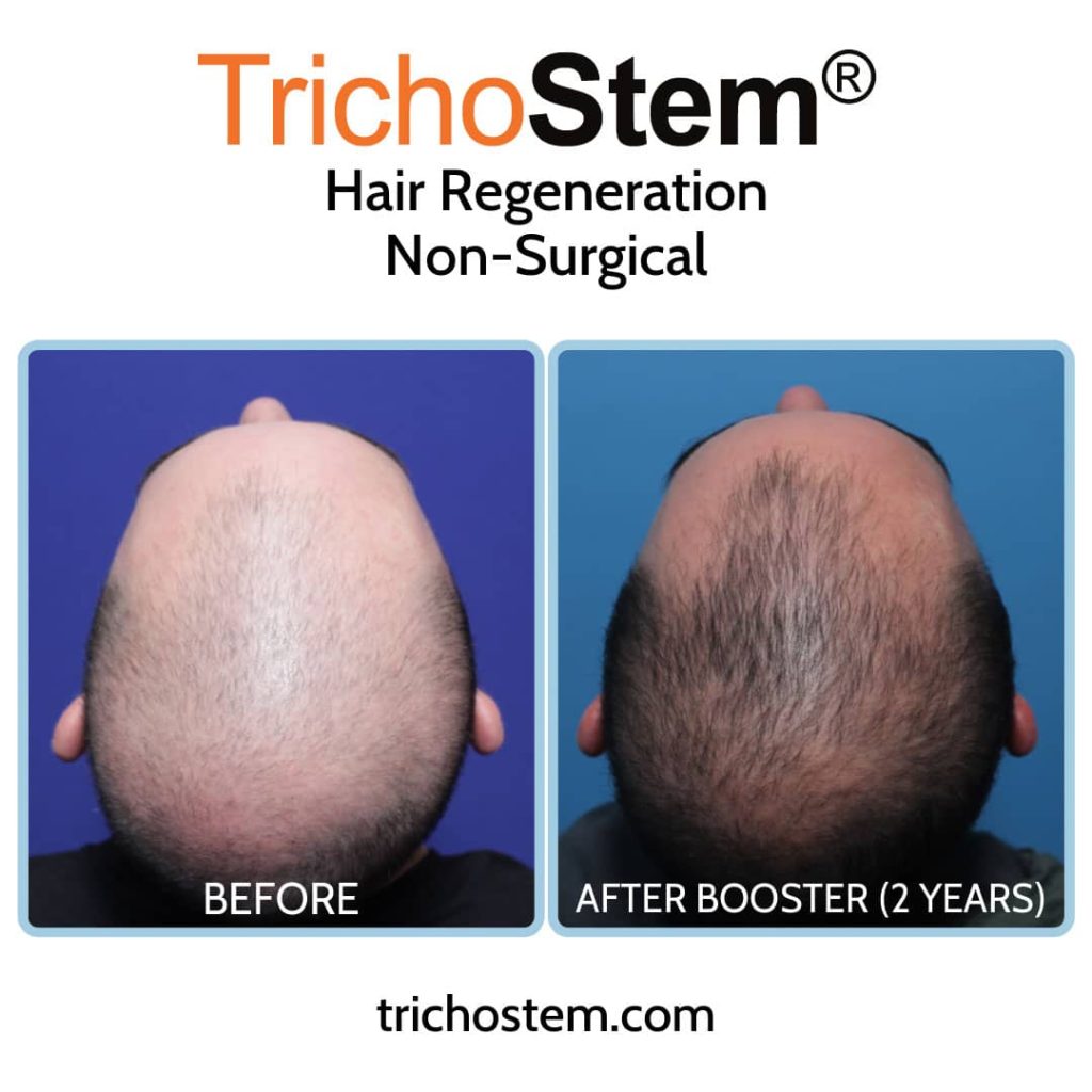 Trichostem Hair regeneration before and after 2 years with booster treatment