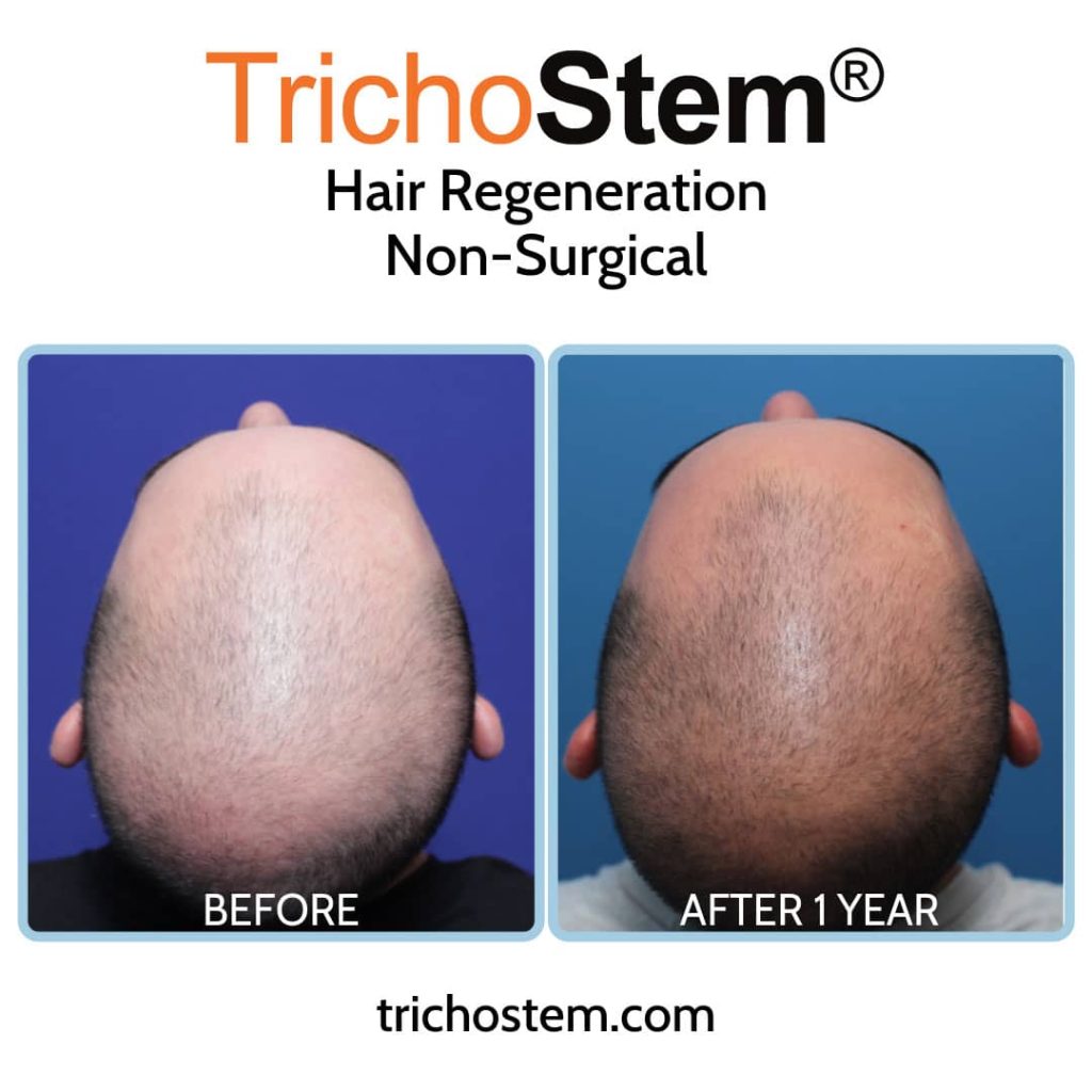 Trichostem Hair regeneration before and after 1 year results