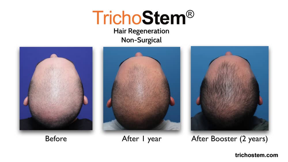 Trichostem Hair regeneration before and after 1 year, and after 2 years with booster treatment