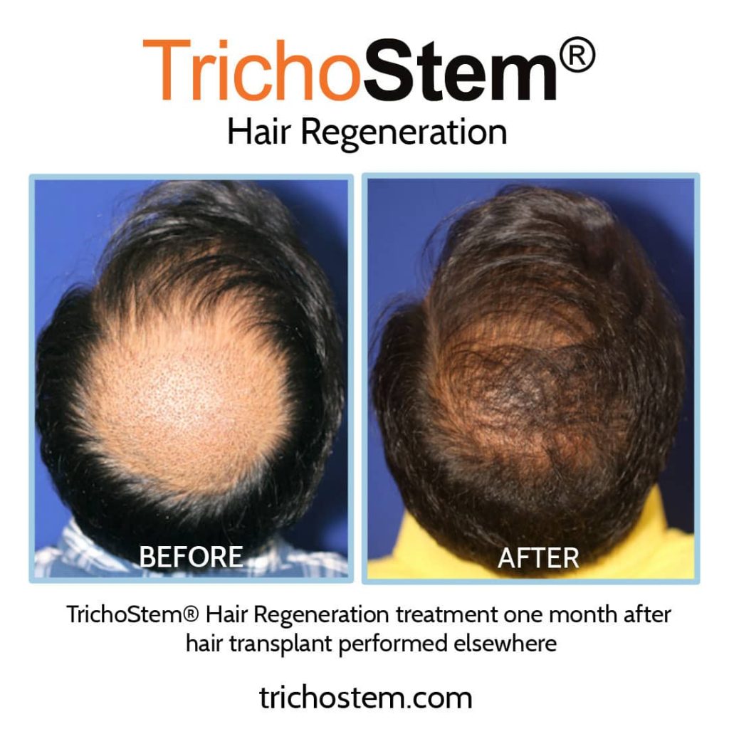 Trichostem hair regeneration treatment on patient who had hair transplant surgery before and after