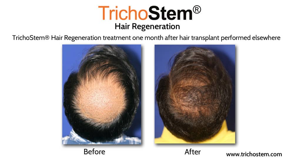 Trichostem hair regeneration treatment before and after results on patient who had hair transplant surgery done elsewhere