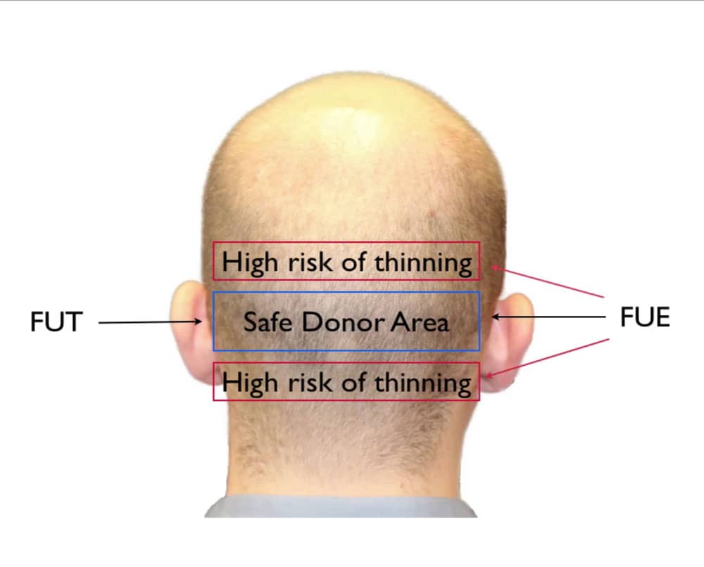 fut vs fue hair grafts prone to thinning