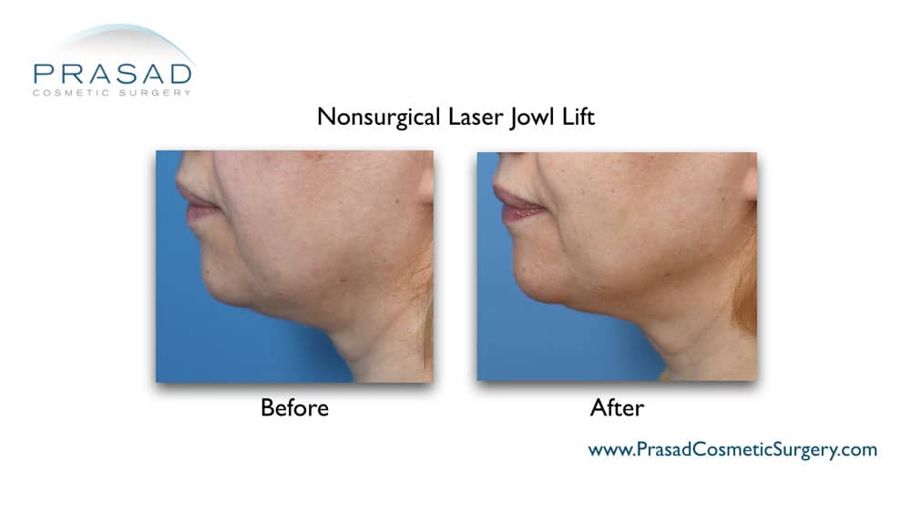 Non-surgical laser jowl lift before and after by Dr. Amiya Prasad Garden City, Long Island