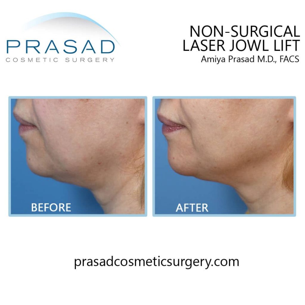 Non-surgical laser jowl lift before and after