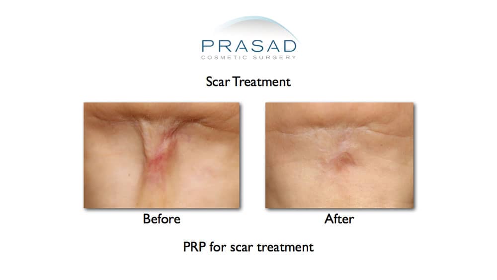 scar treatment before and after