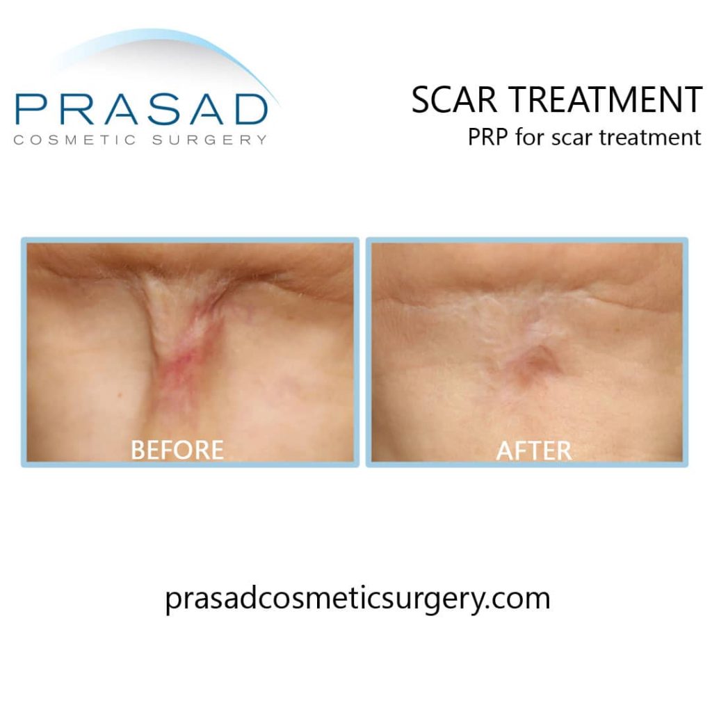 PRP for scar treatment before and after
