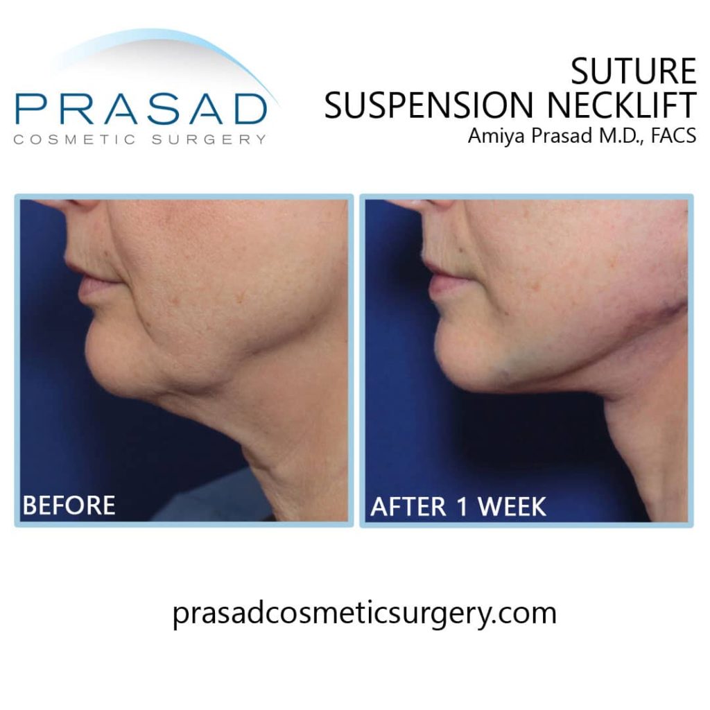 Suture suspension neck lift before and after 1 week recovery