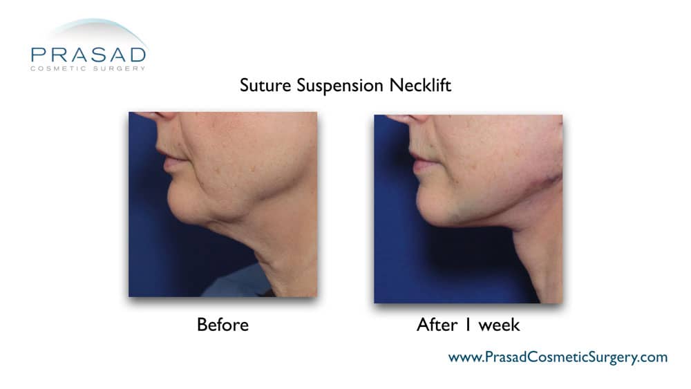 Suture suspension neck lift before and after 1 week recovery procedure done by Dr. Amiya Prasad Garden City, Long Island