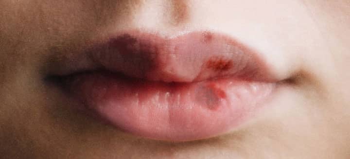 bruising after lip injection filler