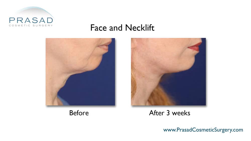 Facelift and neck lift before and after recovery 3 weeks procedure by Dr. Amiya Prasad, Manhattan New York