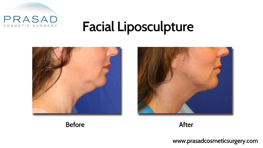 Facial liposculpture - Double chin liposuction before and after