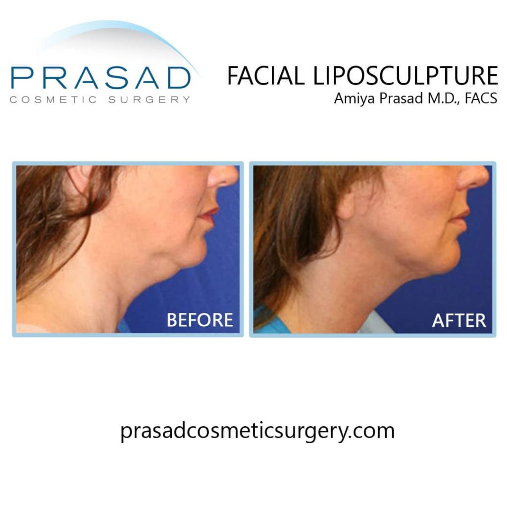 Facial liposculpture - Double chin lipo treatment before and after at Prasad Cosmetic Surgery New York