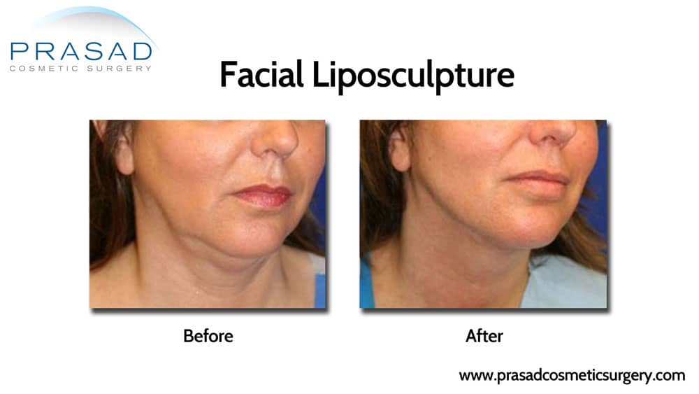 Facial liposculpture - Double chin treatment at Prasad Cosmetic Surgery New York