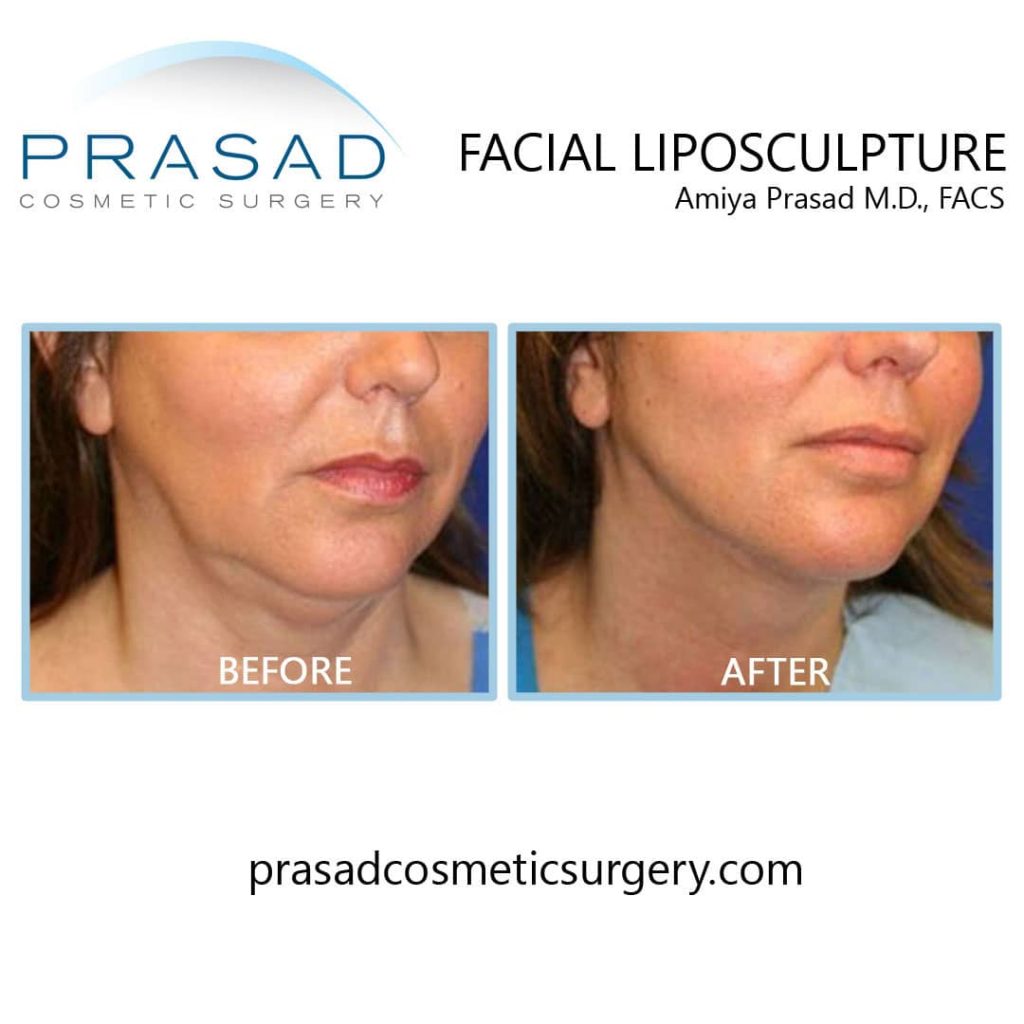 Facial liposculpture - Double chin treatment by Dr. Amiya Prasad New York