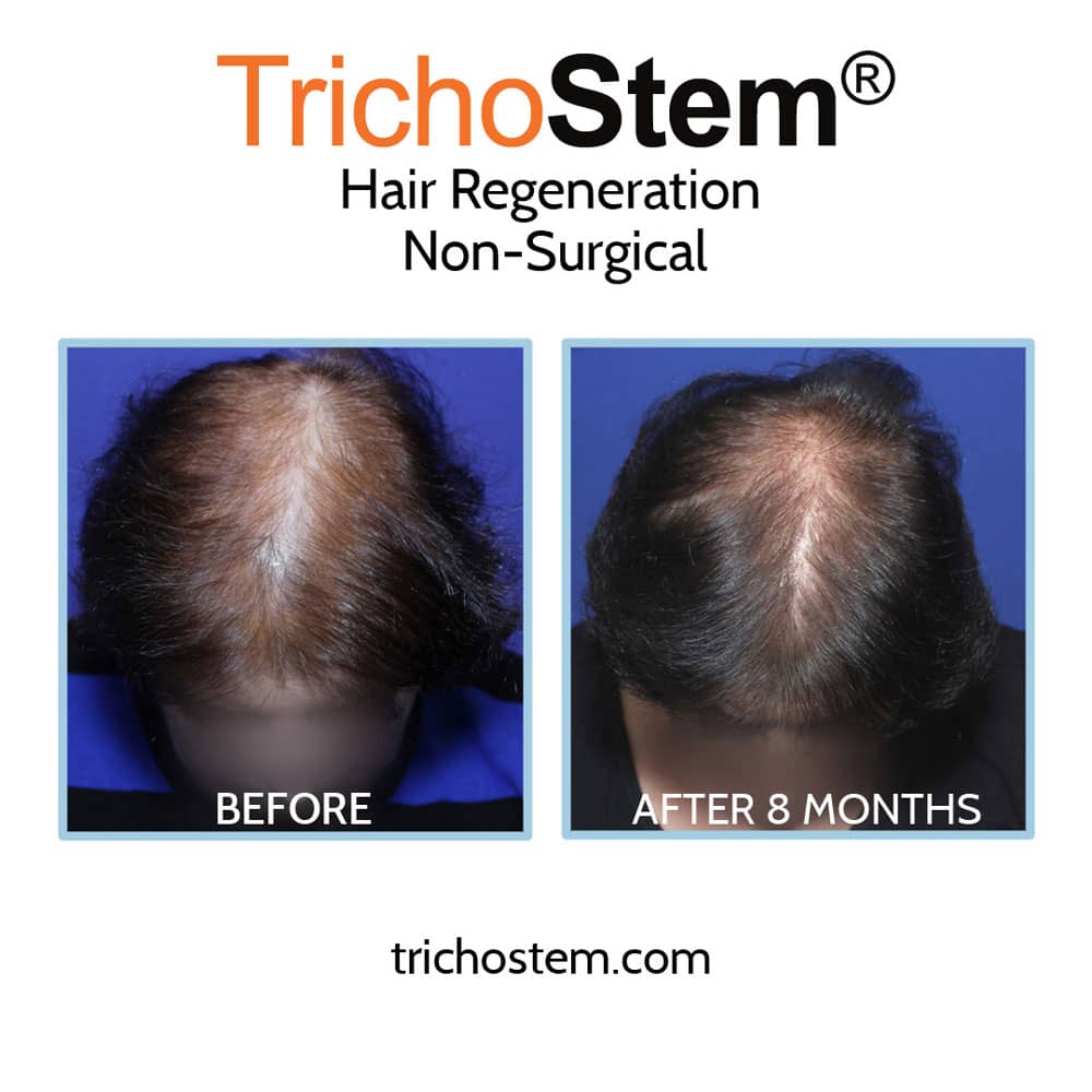 Female pattern hair loss before and after Trichostem hair regeneration treatment