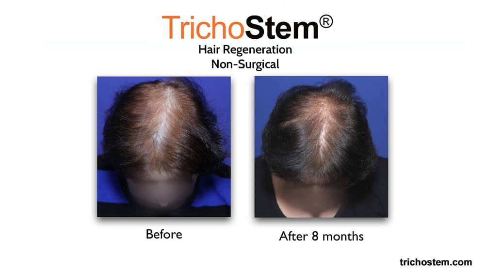 Trichostem hair regeneration treatment before and after 8 months on female pattern hair loss