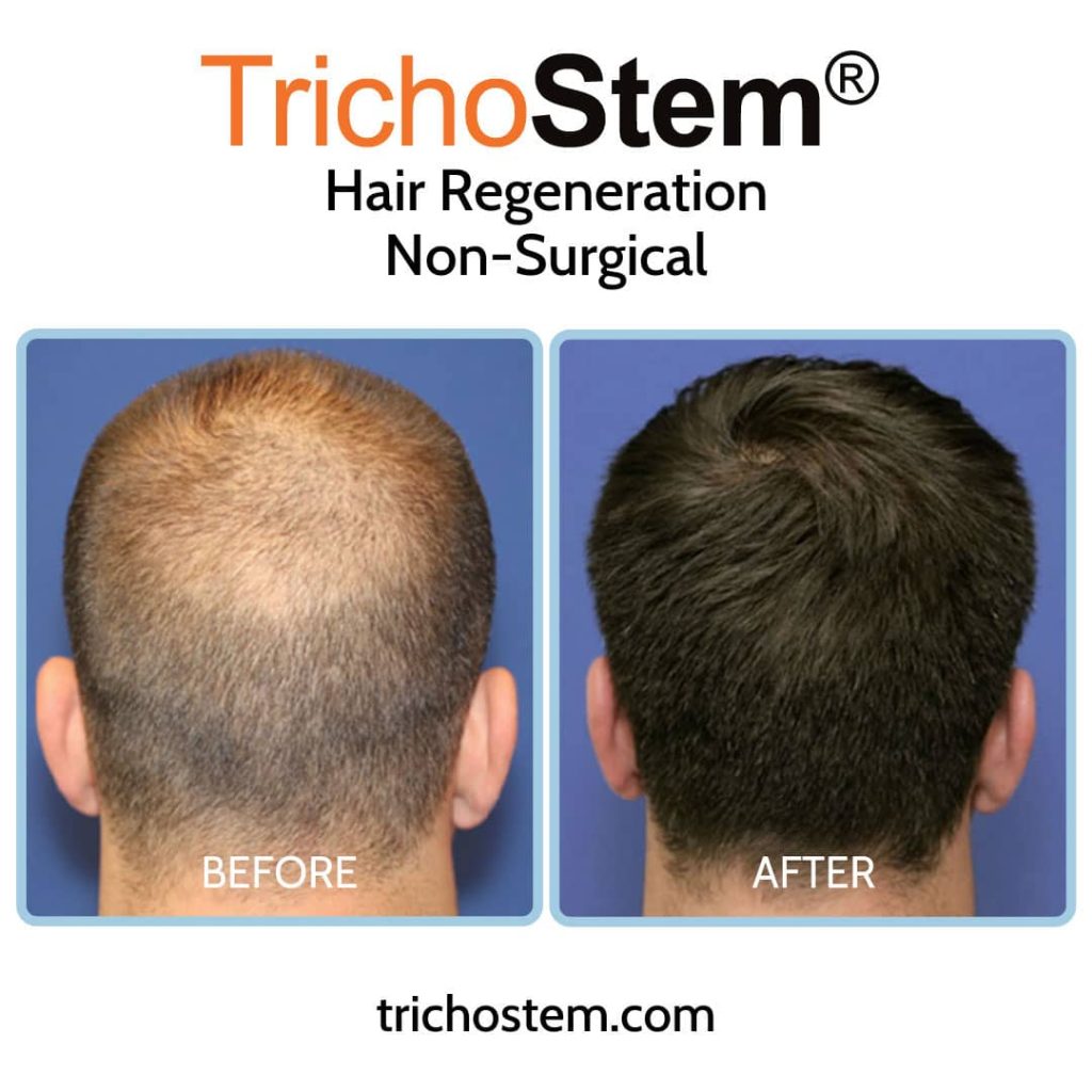 Trichostem Hair Regeneration treatment before and after - best hair transplant alternative