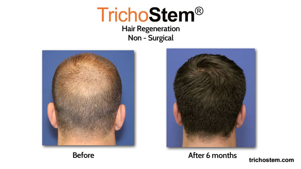 Trichostem Hair Regeneration treatment before and after - no hair transplant scars