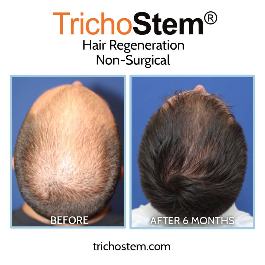 hair regeneration before and after male