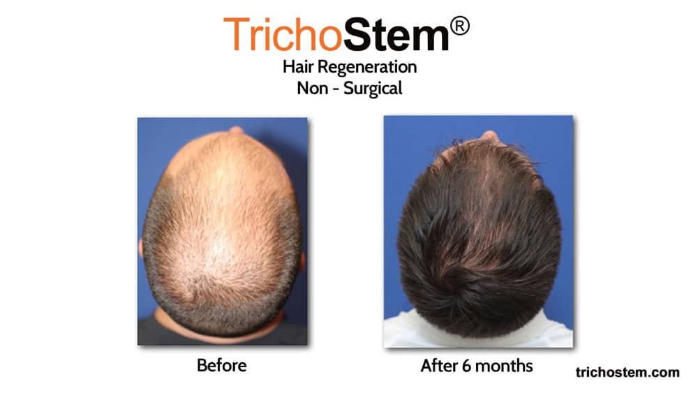 acell + PRP hair regeneration before and after 6 months male