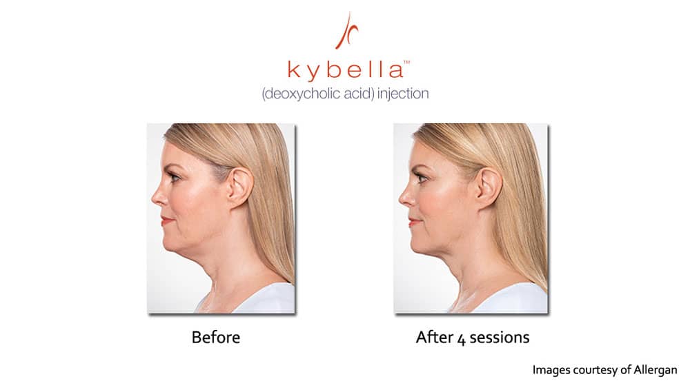 Kybella injection before and after 4 sessions